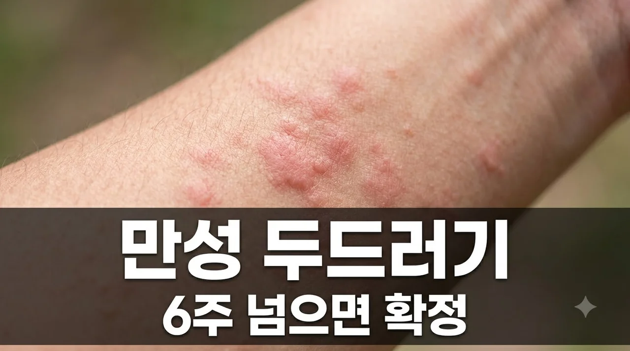 두드러기 6주 넘으면 ‘만성’ 판단 기준 및 원인 완벽정리